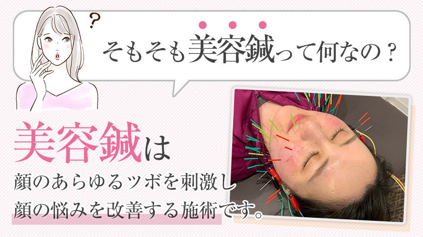 美容鍼は顔のあらゆるツボを刺激し 顔の悩みを改善する施術です