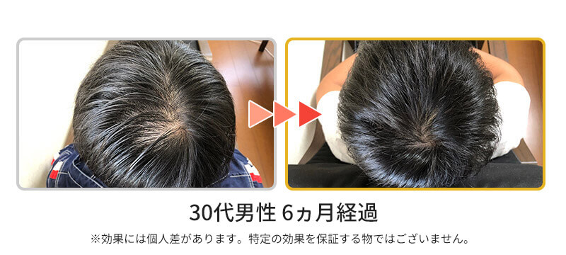 発毛ビフォーアフター