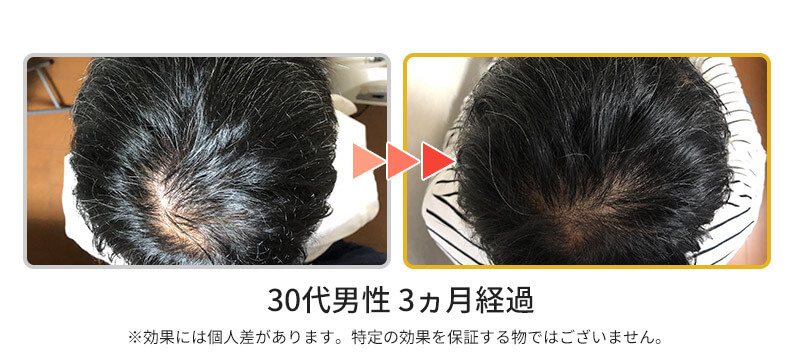 発毛ビフォーアフター