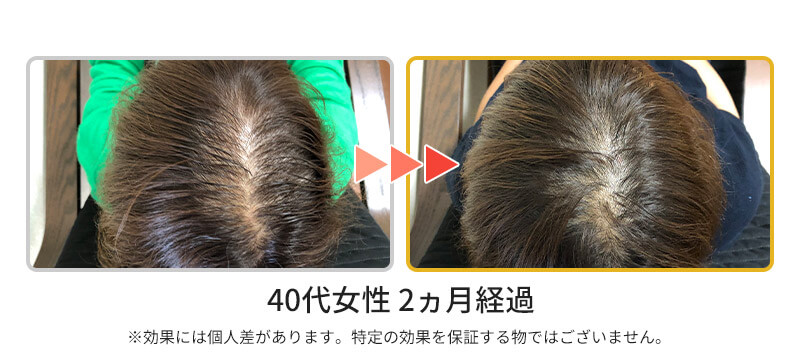 発毛ビフォーアフター