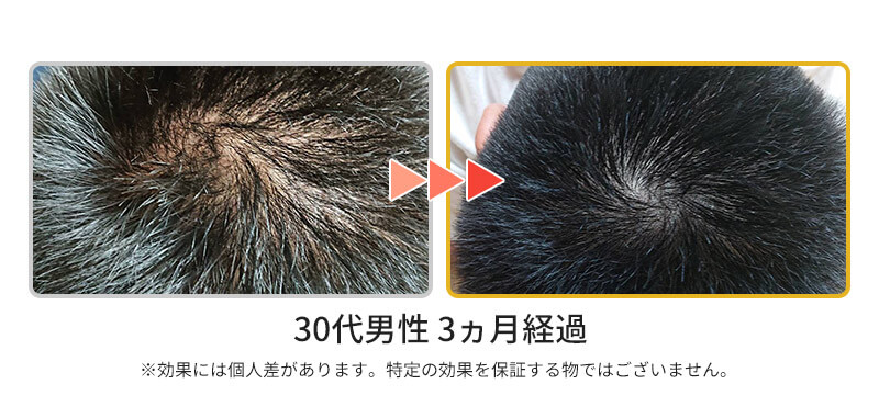 発毛ビフォーアフター
